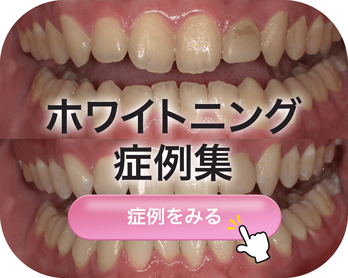 ホワイトニング症例集
