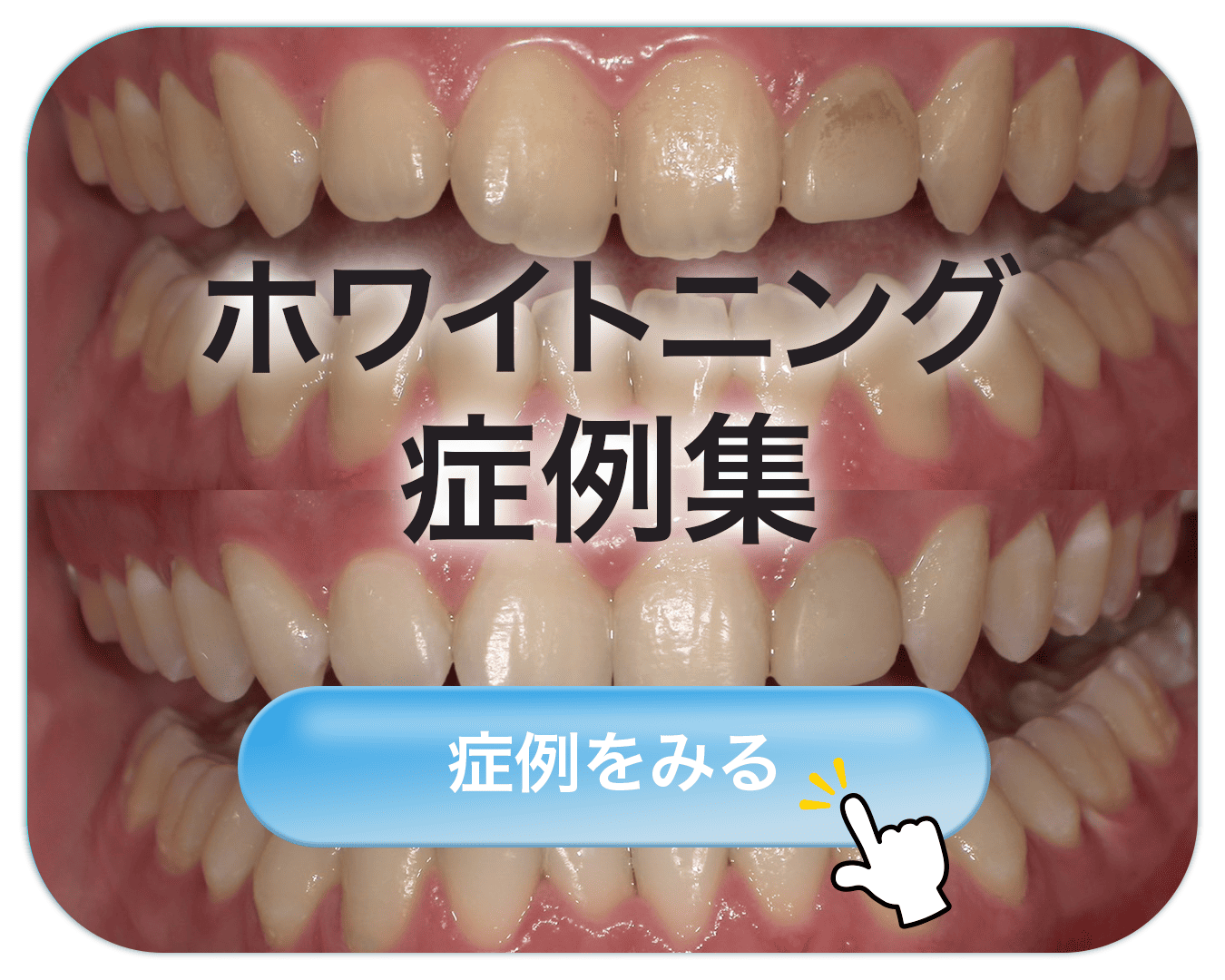 ホワイトニング症例集