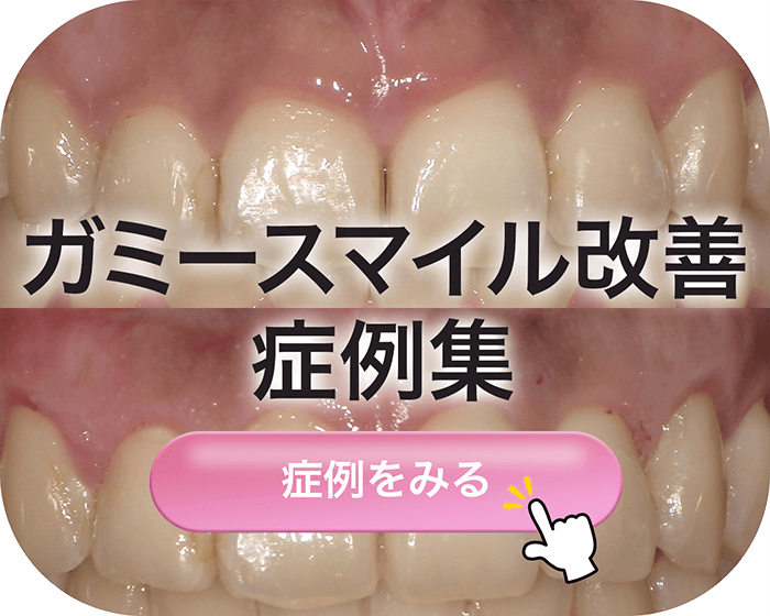 ガミースマイル改善症例集