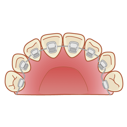 舌側矯正(裏側矯正)のイラスト
