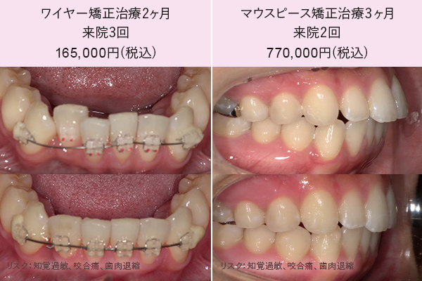 早い矯正治療