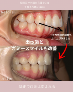 「出っ歯を上下4本抜歯の矯正治療で改善した症例|前歯の突出感と位置の変化を比較」