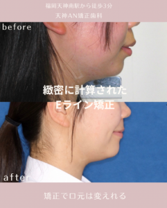 「口ゴボ・出っ歯の抜歯矯正によるEラインと横顔の変化|福岡・天神AN矯正歯科の症例写真」