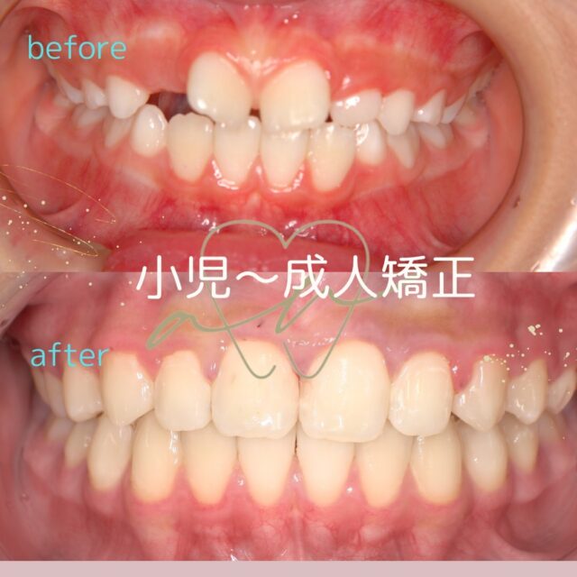 矯正治療