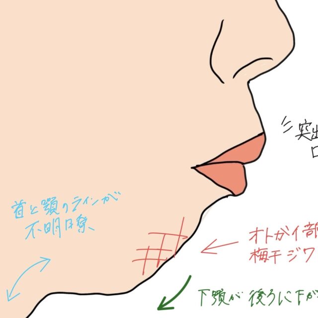 口ゴボの原因は歯？それとも骨格？タイプ別に分かる口元の治し方